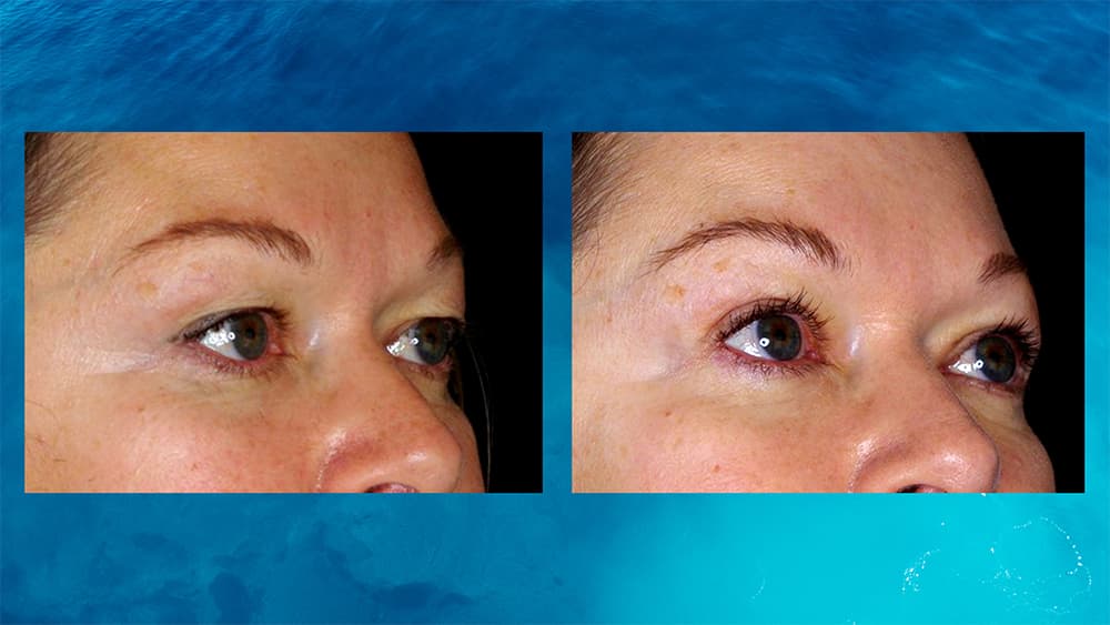 Female before and after photos of eyelid surgery