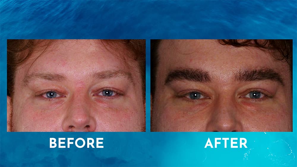 Male before and after photos of eyelid surgery