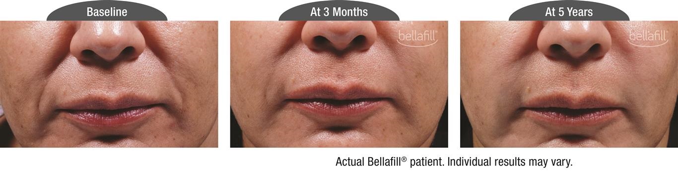 A facial filler patient's long-term progress