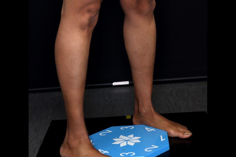 Calf Implants Before & After Image
