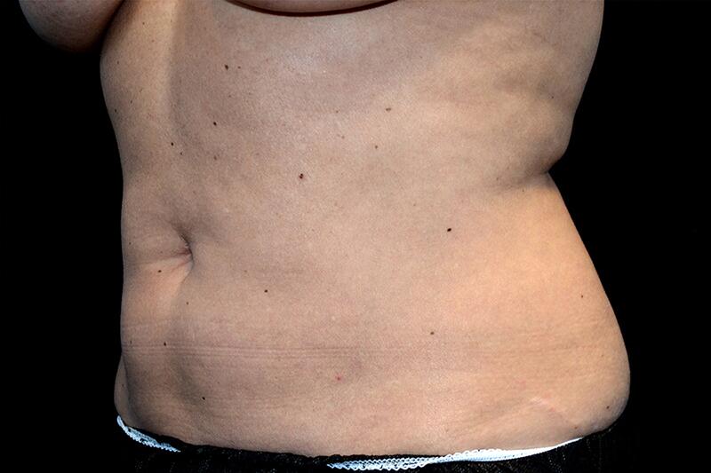 Coolsculpting Before & After Image