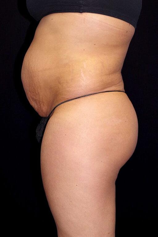 Body Fat Transfer Before & After Image