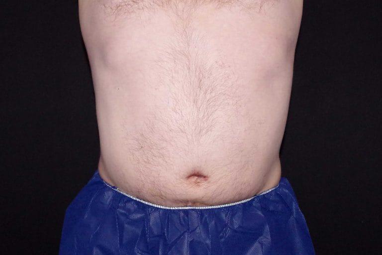 Muscle Plication Before & After Image