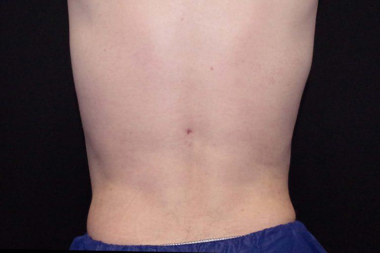 Muscle Plication Before & After Image