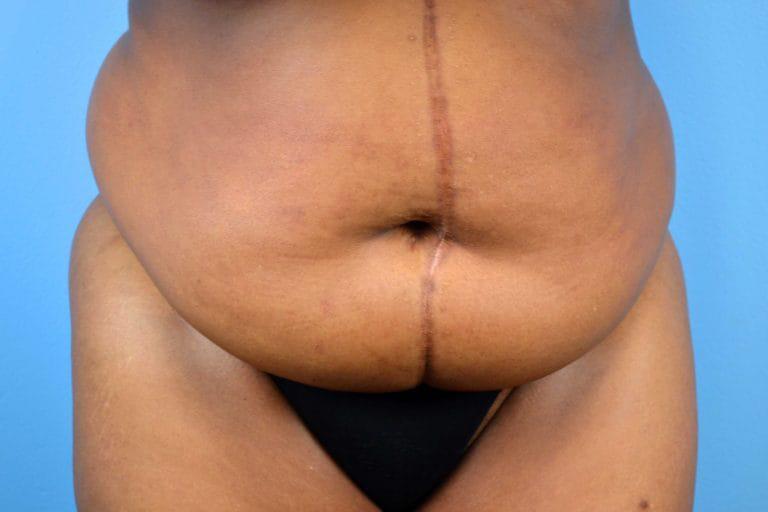 Panniculectomy Before & After Image