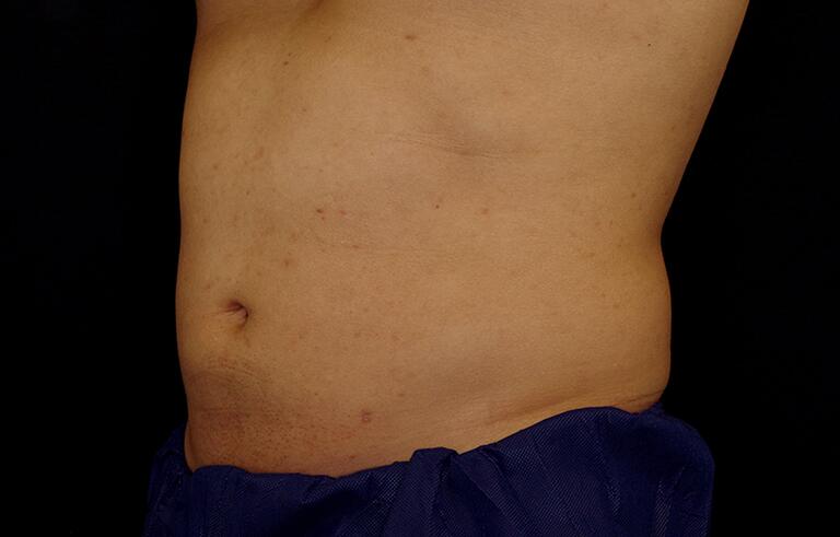 Smartlipo Before & After Image