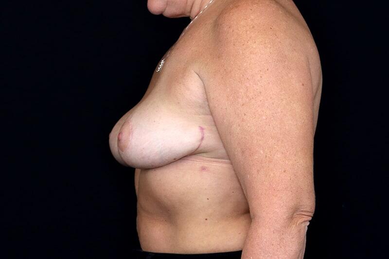 Breast Implant Removal Before & After Image