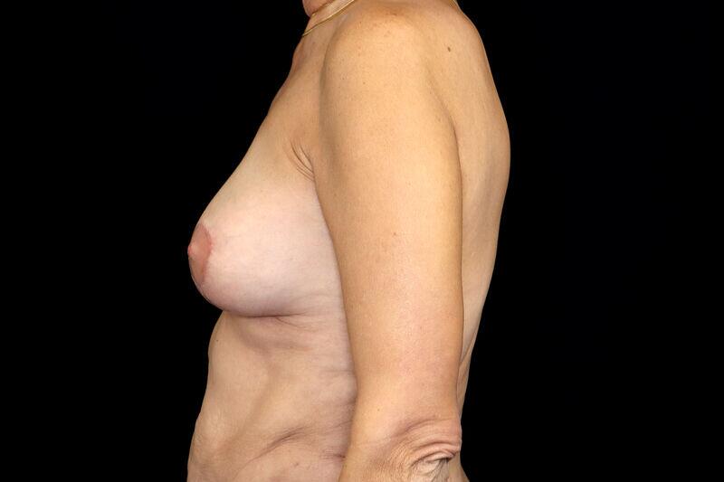 Breast Fat Transfer