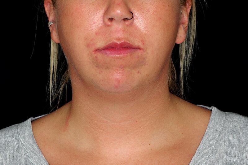 Chin Enhancement Before & After Image