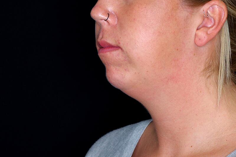 Chin Enhancement Before & After Image