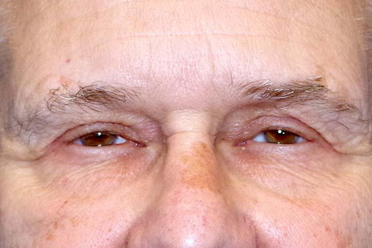 Eyelid Surgery Before & After Image