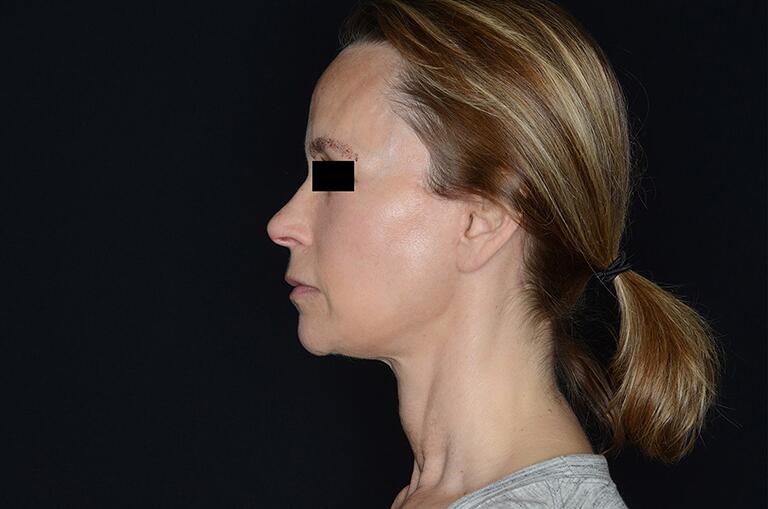Face Fat Transfer Before & After Image