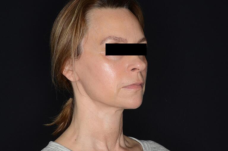 Face Fat Transfer Before & After Image
