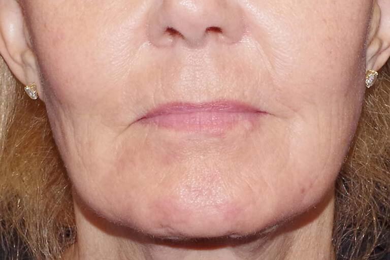 Co2 Laser Resurfacing Before & After Image