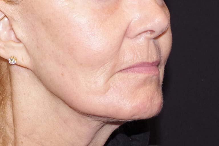 Co2 Laser Resurfacing Before & After Image