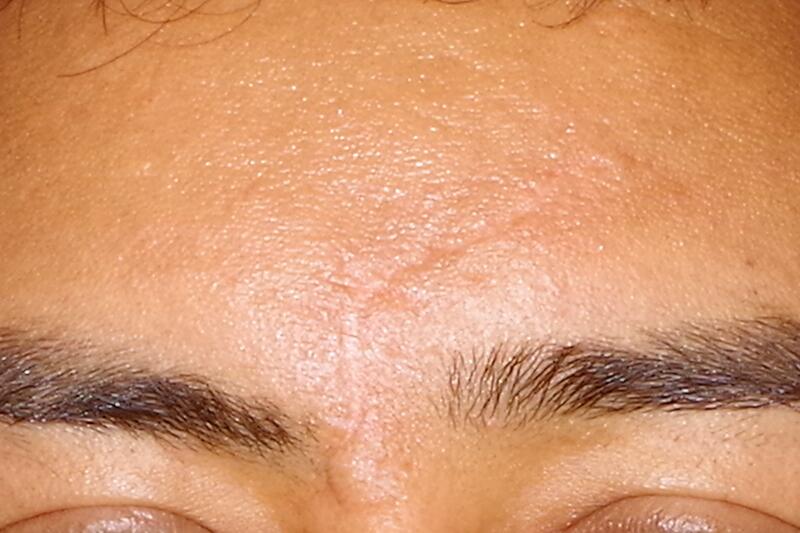 Cynosure (IPL) Before & After Image