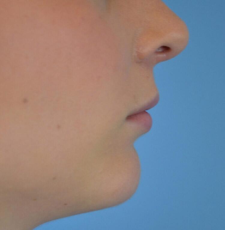 Restylane Before & After Image