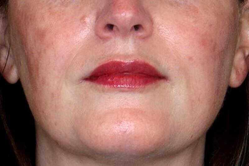 Restylane Before & After Image